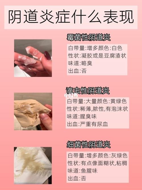                                                                                 豆腐渣是繼女性尿道口排出的白色組織,也稱為白帶