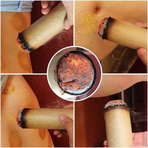 艾灸治療原理是通過(guò)對(duì)穴位的熱蒸和電的熱敷作用,來(lái)治療各類疾病
